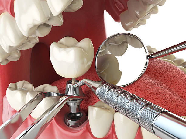 Best Emergency Broken Tooth Repair in Gibsonton, FL